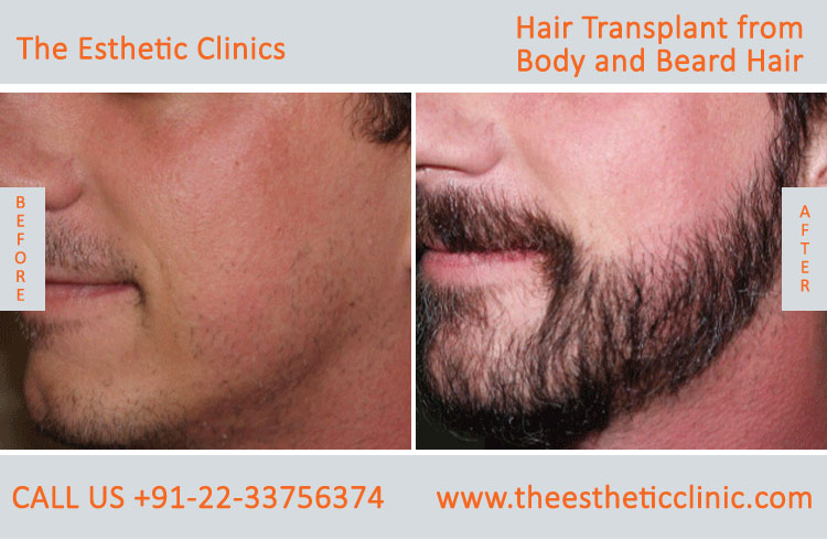 Hair Transplant from Body and Beard Hair before after photos mumba (4)